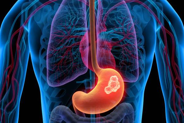 Stomach & Upper Digestive Tract Cancer